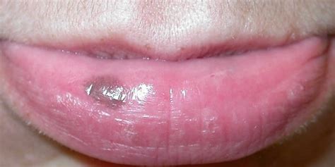 melanoma black spot on lower lip